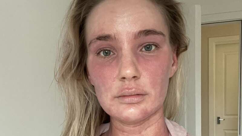 Woman no longer recognises herself after eczema cream 