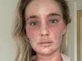 Woman no longer recognises herself after eczema cream 'burns' skin all over body dqxikeidqkikdinv