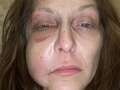Mum nearly loses eye after crashing £180 e-scooter she bought to ride to shops