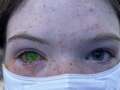 Insect blamed for mystery rise in life-changing illness that alters eye colour dqxikeidqkikdinv