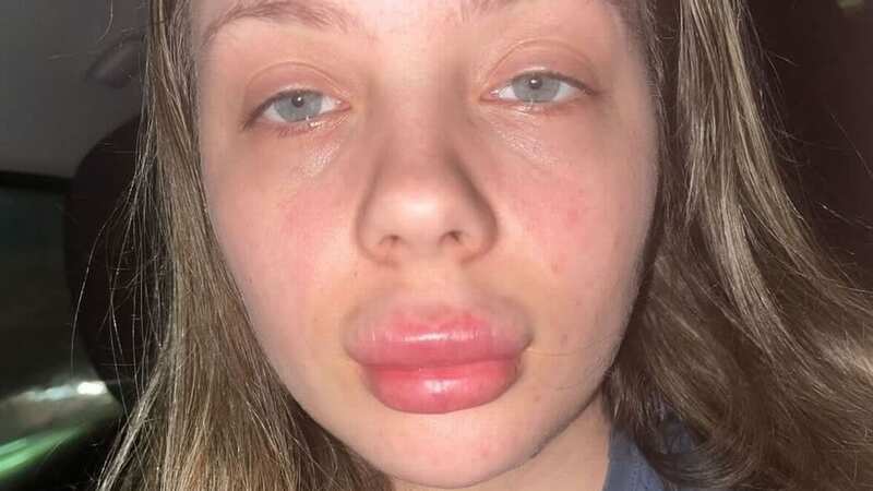 Emma Cornett with the numbing cream before the procedure (Image: Jam Press/@emmaxc__)
