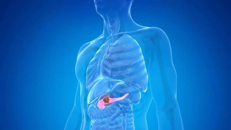 Pancreatic cancer is a highly aggressive disease which has a lower survival rate than other cancers - partly because it is hard to diagnose. (Image: Getty Images/Science Photo Libra)