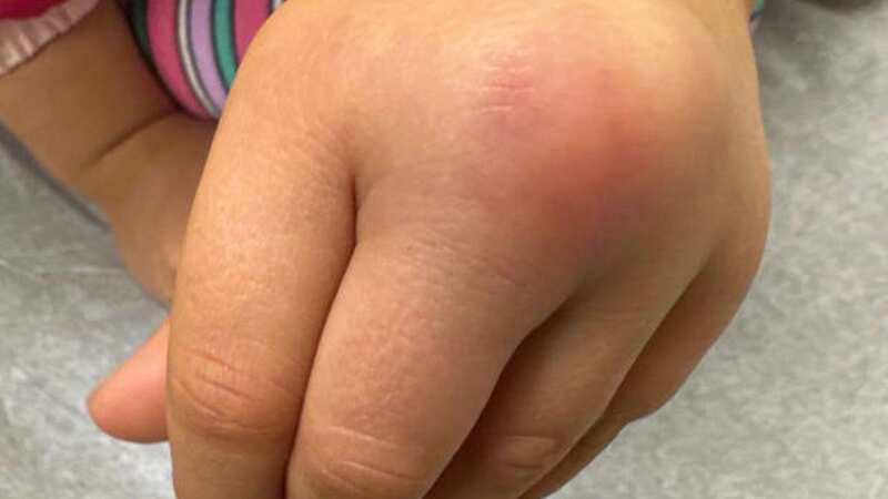 The swelling on the child