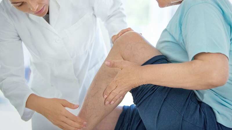 Varicose veins are very common and rarely a cause for concern. (Image: Getty Images)