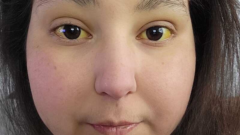 Alcoholic mum whose eyes turned bright yellow unrecognisable since going sober