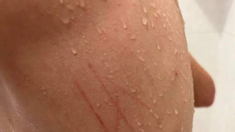 The non-verbal autistic Jewish boy had a swastika carved into his skin (Image: Israeli-American Council)
