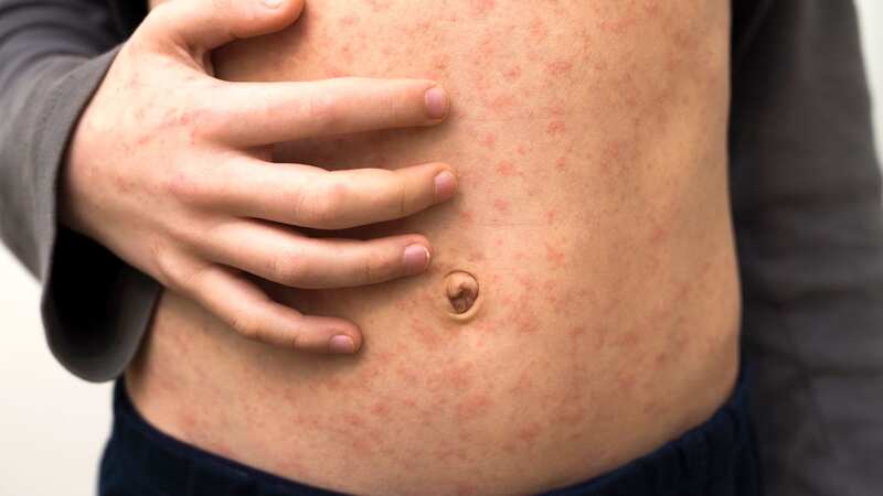 Seven key symptoms of measles as highly infectious disease cases surge in UK