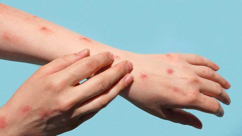 Generally, after one to three days, a distinct bumpy rash begins to develop (Image: Getty Images/iStockphoto)