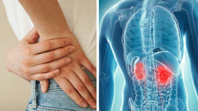 There are around 13,000 new cases of kidney cancer every year - and it can be hard to spot. (Image: Getty Images)