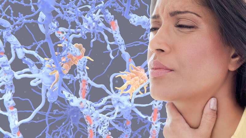 The EBV virus is very common and has been proposed as a possible trigger for multiple sclerosis, says the Multiple Sclerosis Trust. (Image: Getty Images)