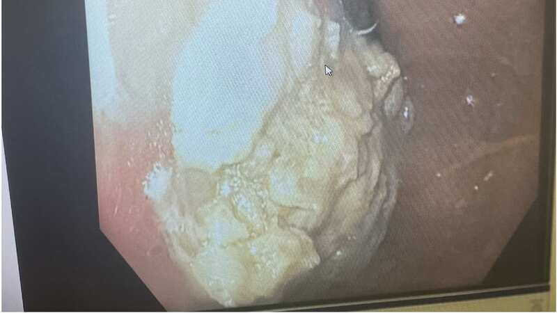 A CT scan showed the chewing gum (Image: sciencedirect)