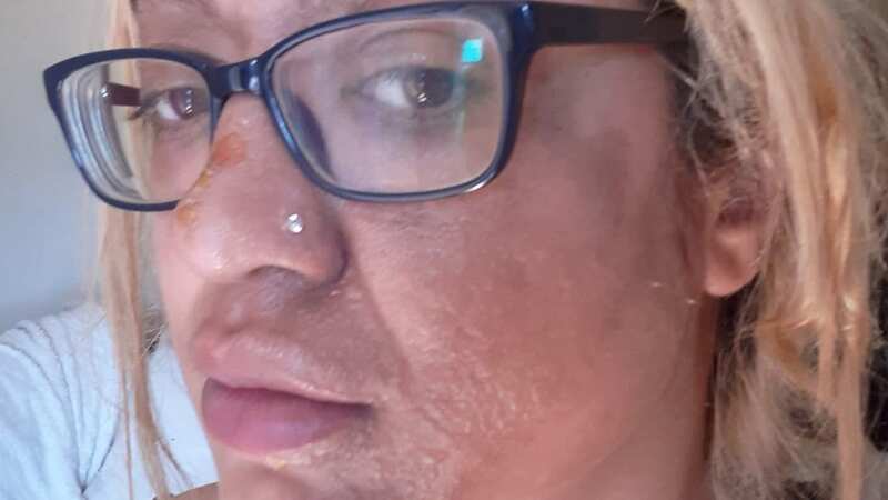The hack left her with horrific burns (Image: Shafia Bashir / SWNS)