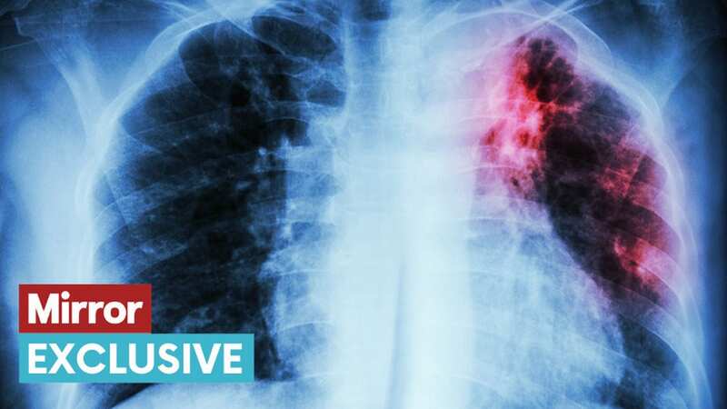 Ancient deadly disease may be tackled via DNA as UK mutant superstrains feared