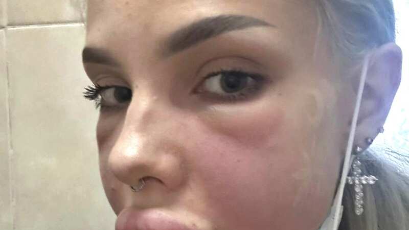 She decided to get a lip reduction after finding lumps in her lips (Image: Newsflash)