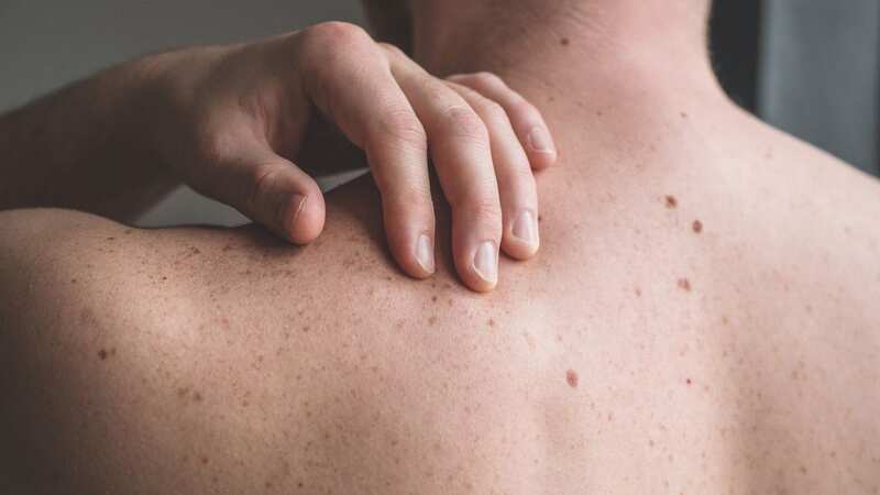 Moles changing on your skin could be indicator of deadly disease