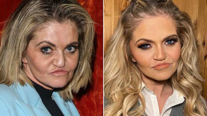 Danniella Westbrook cosmetic surgery journey - nose collapse to crumbling cheeks