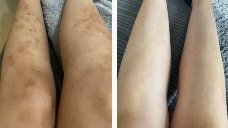 Would you just look at these before and after images of using the Ink Nurse Tattoo Aftercare & Skin Remedy Cream on eczema!