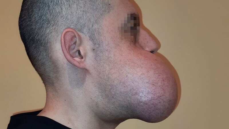 Angelo, 38, before he underwent an eight-hour operation to rebuild his face (Image: Newsflash)