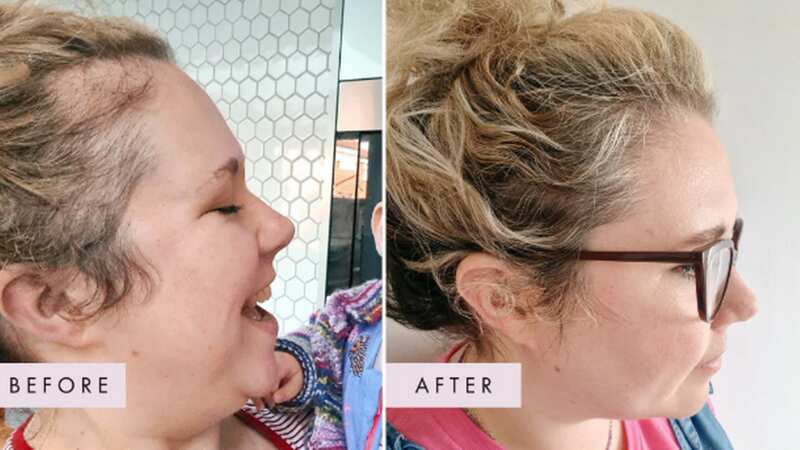 Users have been blown away by their hair growth after taking these capsules daily (Image: Hair Gain)