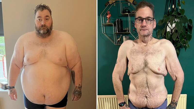 Wayne Shepherd has lost 20 stone and is covered in excess skin (Image: Wayne Shepherd)