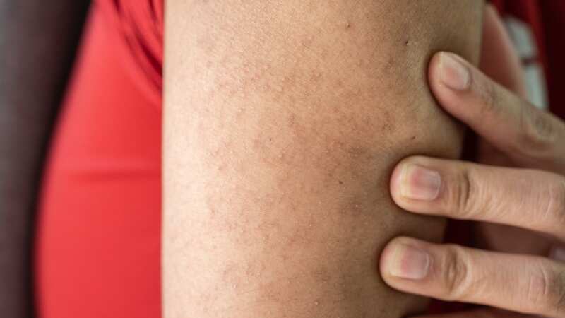 Chicken skin causes dry skin and tiny raised bumps usually on your arms, thighs or bottom (Image: Getty Images)