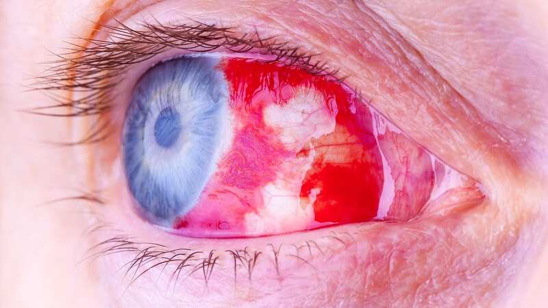Warning to holidaymakers going to Europe as woman dies of eye-bleeding disease