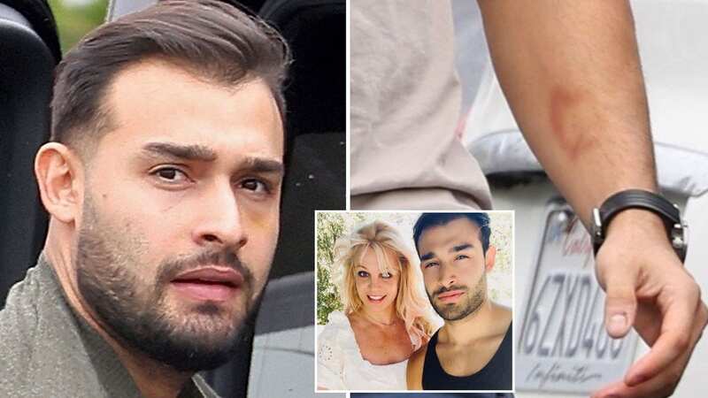 Sam Asghari was spotted with a "black eye" and bitemarks on his forearm after an alleged violent incident with Britney Spears prior to their divorce (Image: BACKGRID)