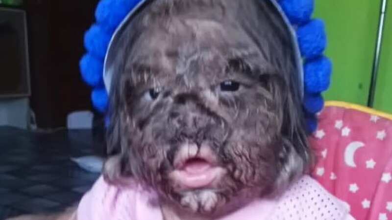 Missclyen Roland from Bintulu, Sarawak in Malaysia has a rare congenital syndrome (Image: Newsflash)