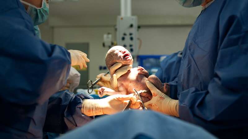 Baby being born via Caesarean Section coming out (Image: Getty Images/iStockphoto)
