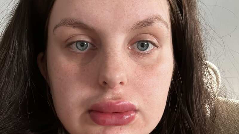 Ellie straight after the treatment (Image: Jam Press)