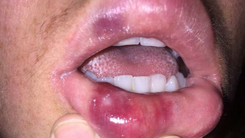 Severe bruising and even rotting lips can result from cheap lip treatments abroad (Image: Ever Clinic / SWNS)