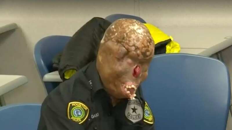 Zaid Garcia suffered burns to 80 per cent of his body (Image: KPRC-TV)