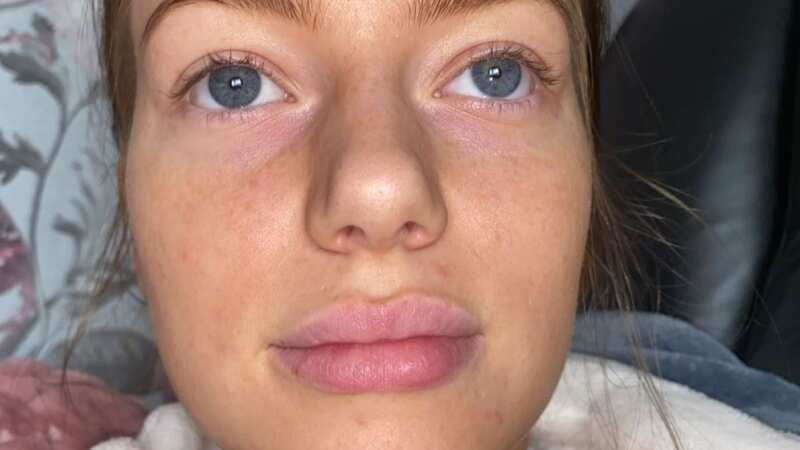 Grace Keeler, from Liverton Mines in Middlesbrough, claims the woman who injected her with 1.1ml fillers burst a blood vessel in her lips (Image: Kennedy News & Media)