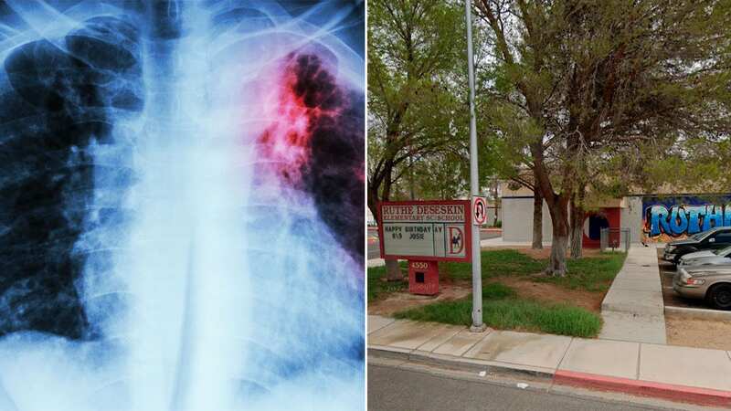Tuberculosis can be treated with antibiotics (Image: Getty Images)
