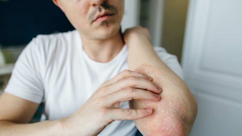 Itchy skin is a common symptom of bile duct cancer (Image: Getty Images)