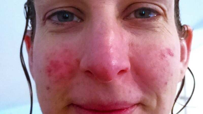 Anna said her face turned into a 