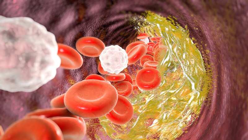 Men and women with high levels of HDL had an increased risk of dementia and Alzheimer