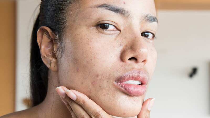 You can banish acne with one drink (stock photo) (Image: Getty Images/EyeEm)