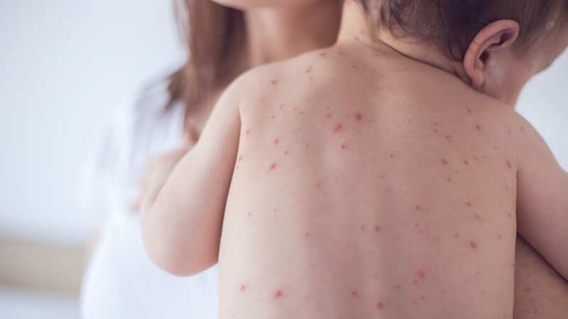 Brits have been urged to get the MMR vaccine (Image: Getty Images/iStockphoto)