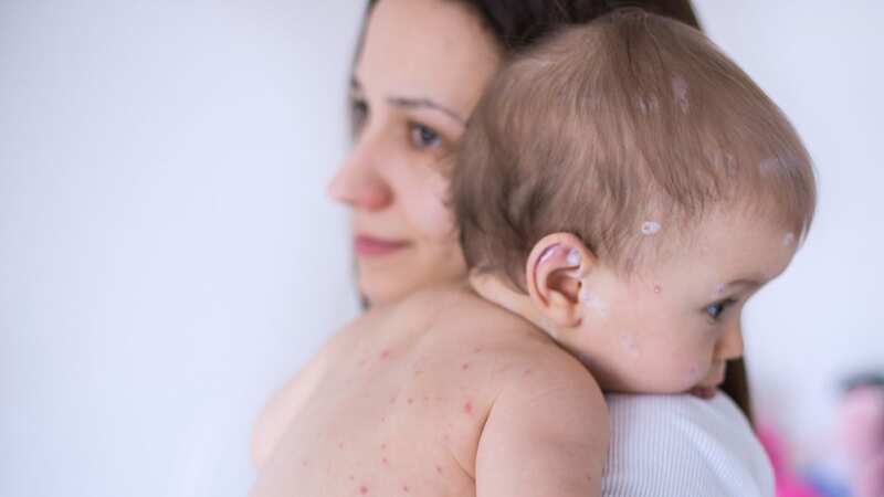 The rash is the most common symptom, but it doesn