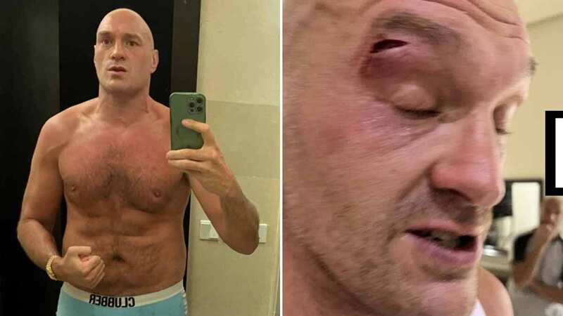 Tyson Fury issues fresh update about Oleksandr Usyk fight after suffering injury