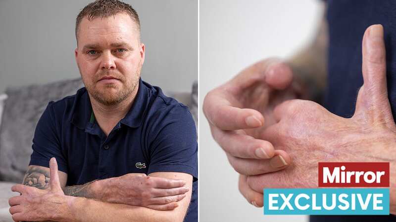 Steve Gilmore was hit by an electric shock (Image: Adam Gerrard / Daily Mirror)