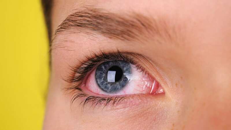 Eye cancer is rare - but diagnoses in the UK are expected to rise (Stock photo) (Image: Getty Images)