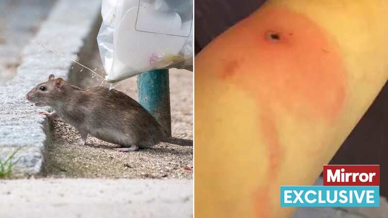 Alaskapox, also known as AKPV, is related to smallpox, cowpox, and mpox (Image: Alaska Department of Health)