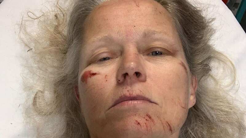 Janicke Tvedt in Leeds Hospital after being attacked by cows (Image: Janicke Tvedt / SWNS)