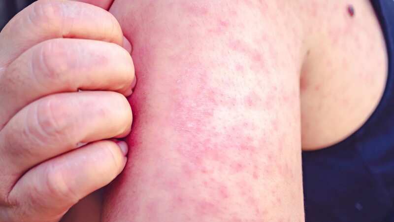 Measles outbreak: New landmark case of Victorian-era disease confirmed in UK