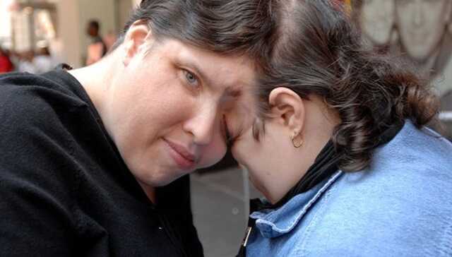 World’s oldest conjoined twins die after lifetime spent fused at the head