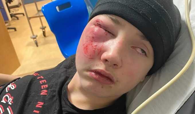 12-year-old boy nearly loses eye after Lynx can explosion in fire