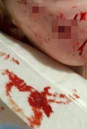 Injuries sustained by children from dogs in Yorkshire. Photo released February 7 2025. A shocking photo shows a teenage girl’s injuries from a horror dog attack - after two other children were also mauled by the animals nearby just days later. South Yorkshire Police say they were called to a property in Rossington, South Yorks., where a 16-year-old girl was attacked by a Cane Corso. The girl had reconstruction surgery in hospital and a shocking photo shows a piece of skin hanging off her body.The dog was destroyed at the scene by firearms officers, with permission from the owner. dqxikeidqkikdinv